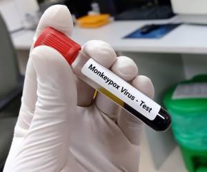 Centroamérica alcanza los 175 casos de viruela símica