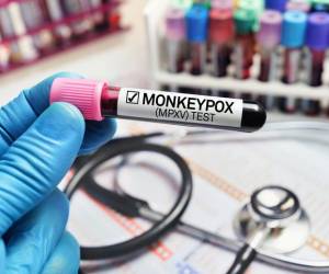 OMS teme que viruela del mono se instale en países no endémicos