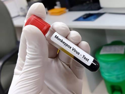 Centroamérica alcanza los 175 casos de viruela símica