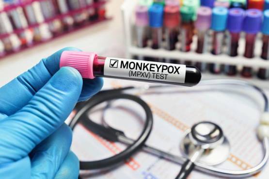 OMS teme que viruela del mono se instale en países no endémicos